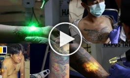 طرح رایگان پاک کردن خالکوبی بدن و صورت (ویدئو)